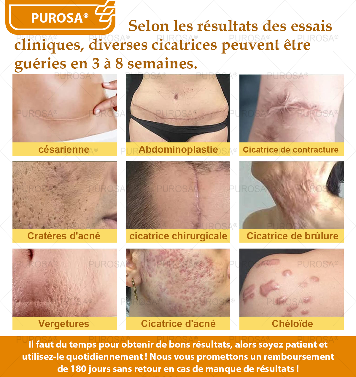 PUROSA® Crème de soin au venin d’abeille – Anti-âge, hydratation, réparation cutanée, unification du teint, traitement de l’acné et des taches brunes, élimination des verrues et des grains de beauté, soulagement du psoriasis