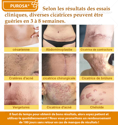PUROSA® Crème de soin au venin d’abeille – Anti-âge, hydratation, réparation cutanée, unification du teint, traitement de l’acné et des taches brunes, élimination des verrues et des grains de beauté, soulagement du psoriasis