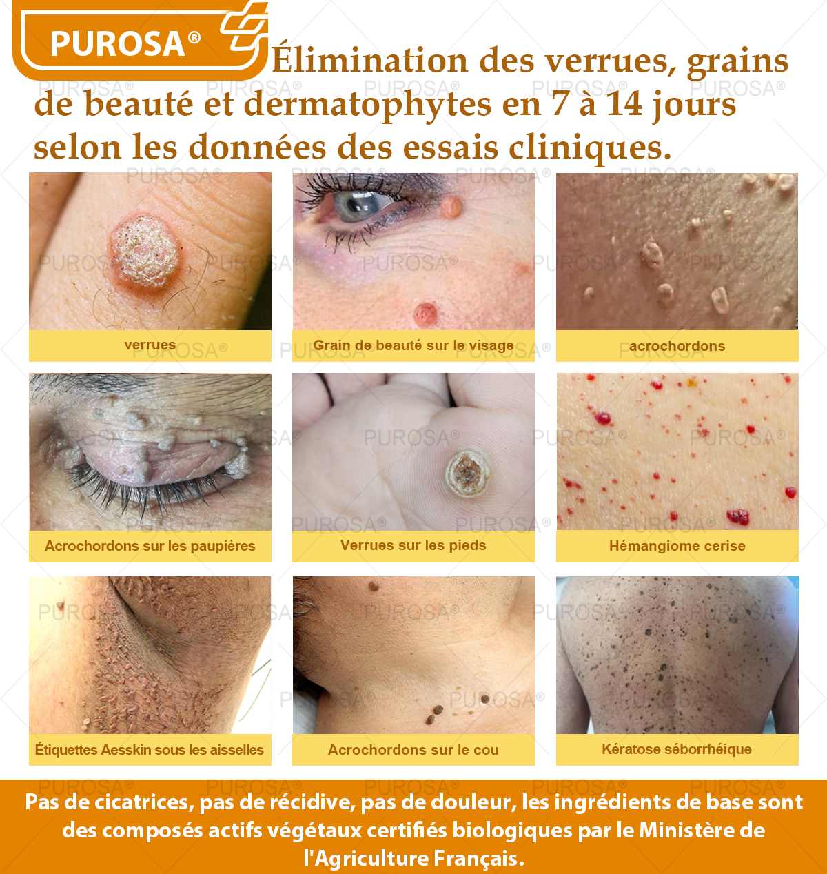 PUROSA® Crème de soin au venin d’abeille – Anti-âge, hydratation, réparation cutanée, unification du teint, traitement de l’acné et des taches brunes, élimination des verrues et des grains de beauté, soulagement du psoriasis