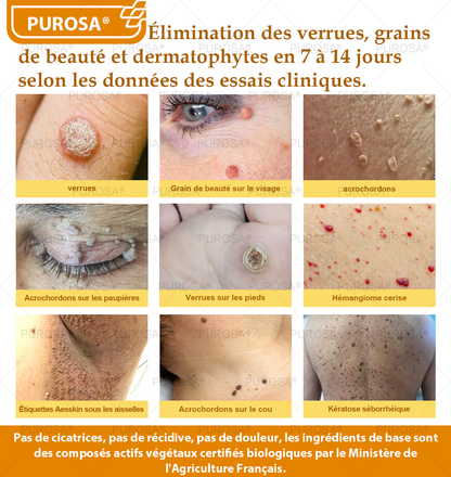PUROSA® Crème de soin au venin d’abeille – Anti-âge, hydratation, réparation cutanée, unification du teint, traitement de l’acné et des taches brunes, élimination des verrues et des grains de beauté, soulagement du psoriasis
