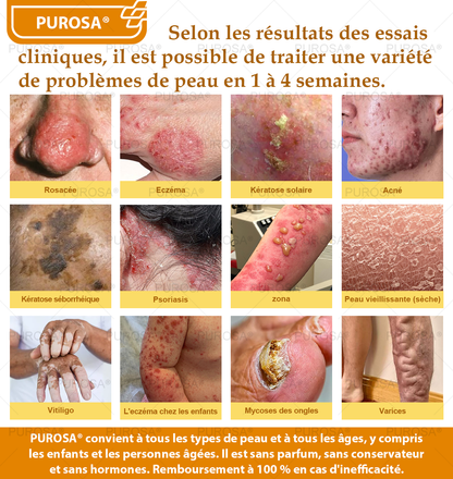 PUROSA® Crème de soin au venin d’abeille – Anti-âge, hydratation, réparation cutanée, unification du teint, traitement de l’acné et des taches brunes, élimination des verrues et des grains de beauté, soulagement du psoriasis